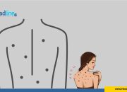 ilustrasi gambar jerawat di badan